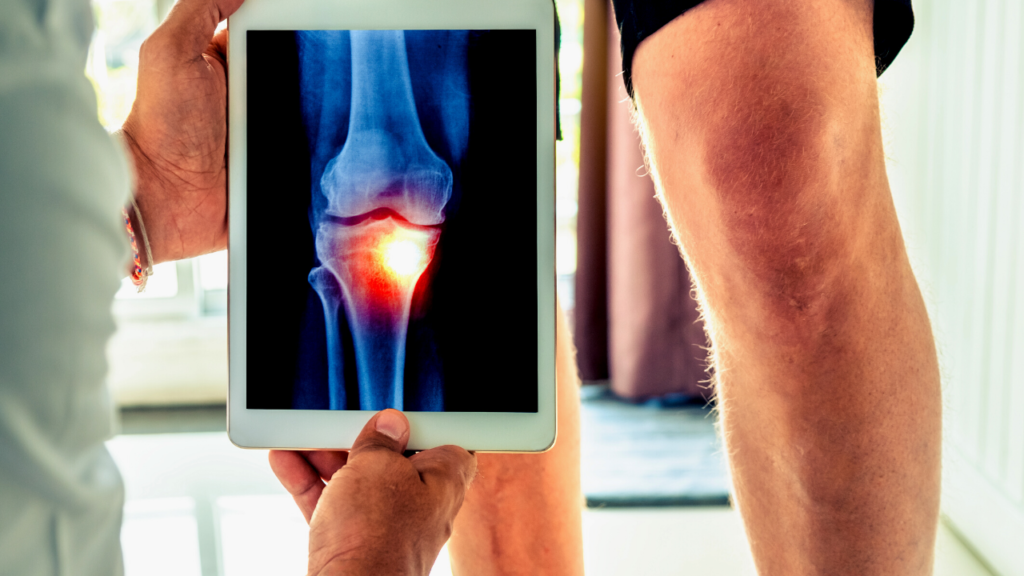 Non-surgical Injection Treatments for Knee Arthritis