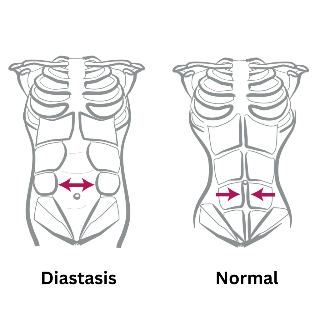Together Tape™ for Diastasis Recti Healing, Non-Surgical Solution