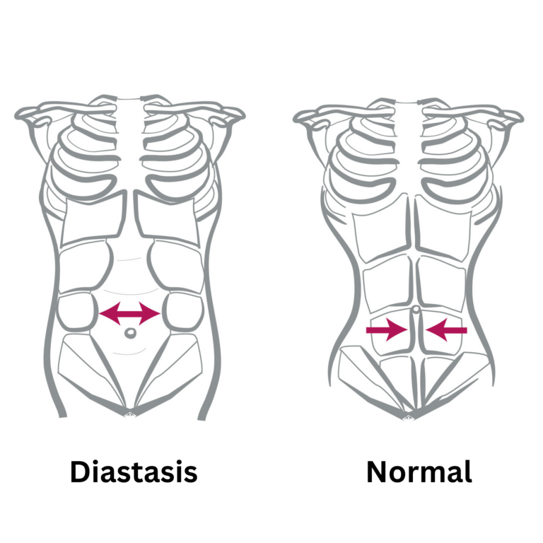 Non-Surgical Diastasis Recti Treatments Los Angeles CA - Dr. Shounuck ...