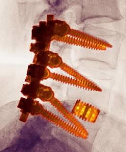 Spinal Fusion Surgery Los Angeles CA